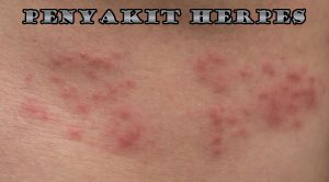 Gejala Penyakit Herpes Secara Umum & Cara Mengobatinya