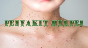 Gejala Penyakit Herpes Secara Umum & Cara Mengobatinya