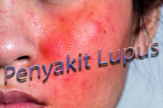Informasi Lengkap Penyakit Lupus